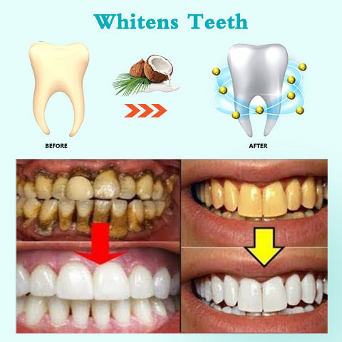 🦷🦷Teeth Whitening Coconut Oil Pulling with 7 Essential Oils and Vitamins. Remove Oral Issues